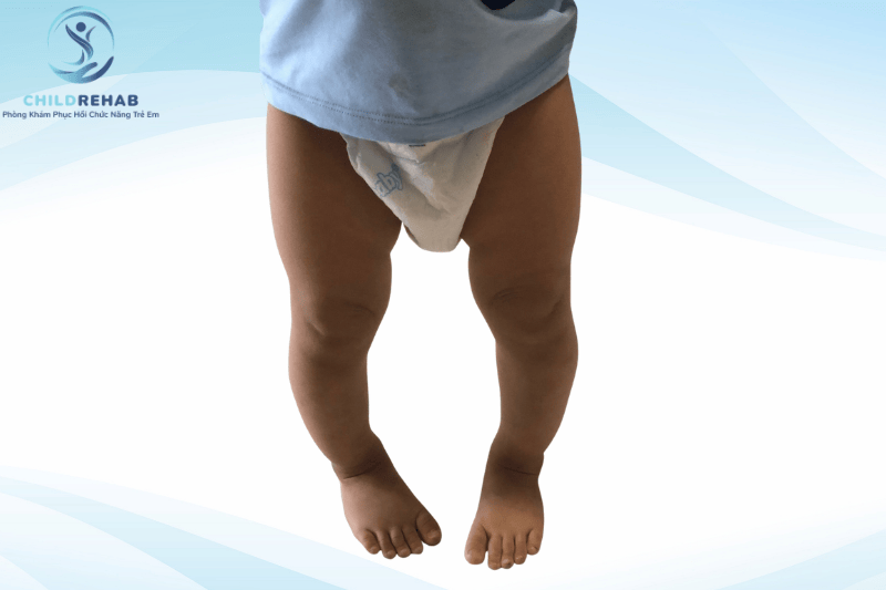 Chân Chữ O Ở Trẻ Em: Khi Nào Cần Can Thiệp? 2026 | ChildRehab