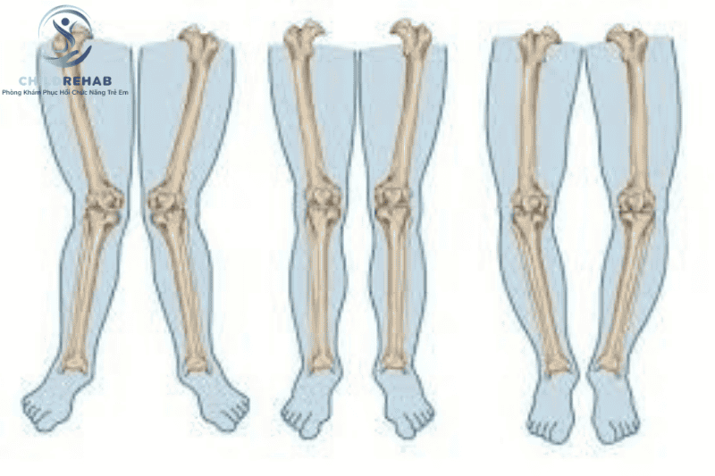 Lệch Trục Chi Dưới Ở Trẻ Em: Khi Nào Cần Điều Trị? 2026 | ChildRehab