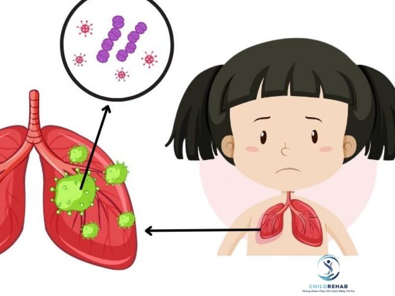 Trẻ Hay Viêm Phổi Tái Phát Có Cần Phục Hồi Hô Hấp? 2026 | ChildRehab