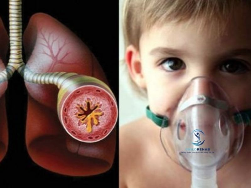 Phục Hồi Hô Hấp Cho Trẻ Hen Phế Quản 2026 | ChildRehab