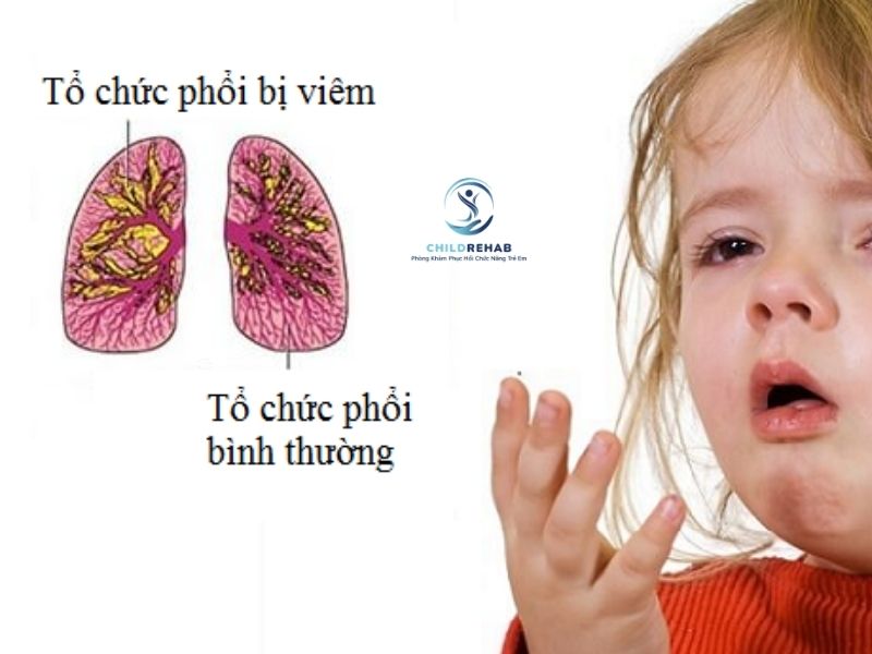 Phục Hồi Hô Hấp Cho Trẻ Viêm Phổi Nặng 2026 | ChildRehab