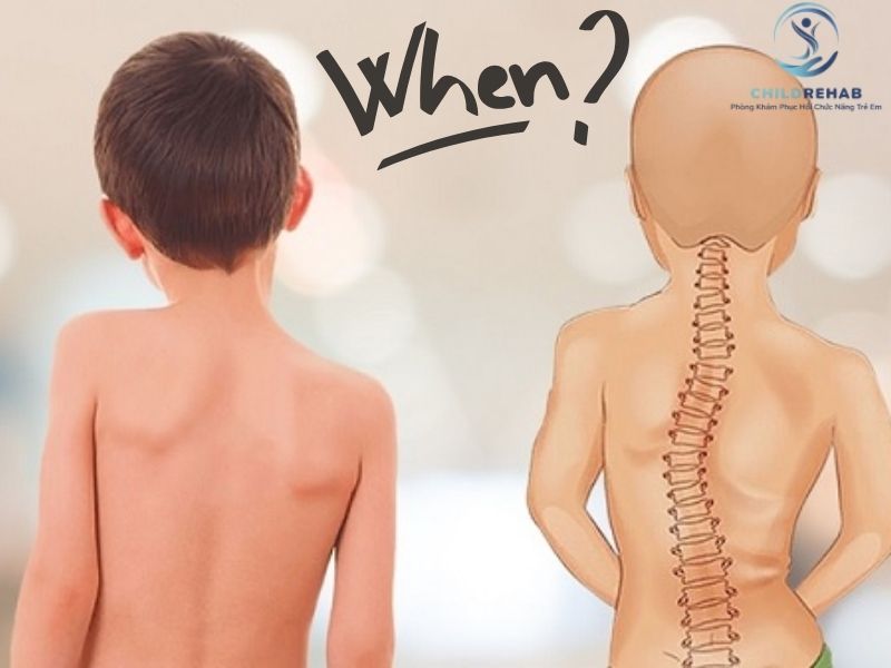 Khi Nào Cong Vẹo Cột Sống Ở Trẻ Không Còn Là Tư Thế Xấu Đơn Thuần? 2026 | ChildRehab