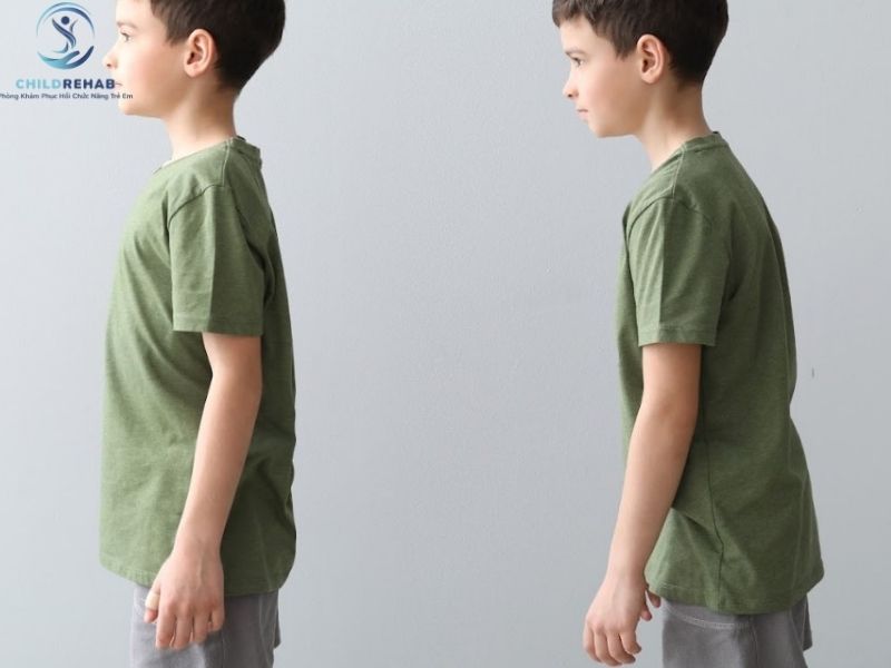 Dáng Đứng Của Trẻ Bị Cong Vẹo Cột Sống Thường Có Gì Khác Thường? 2026 | ChildRehab