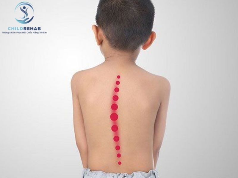 Lưng Trẻ Bị Lệch Sang Một Bên Có Phải Bất Thường Không? 2026 | ChildRehab