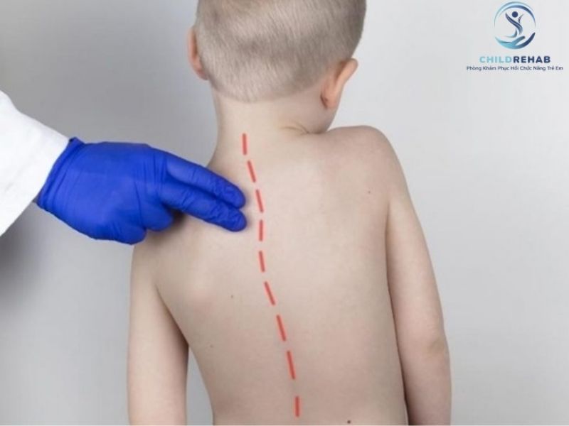 Hai Vai Không Đều Ở Trẻ Có Đáng Lo Không? 2026 | ChildRehab