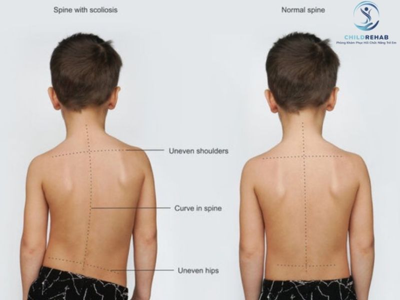 Cong Vẹo Cột Sống Ở Trẻ Có Nguy Hiểm Không? 2026 | ChildRehab