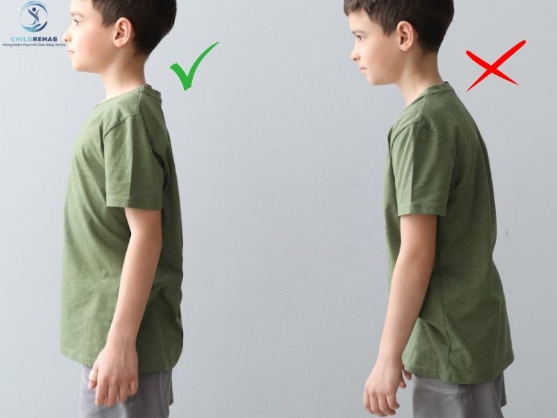 Dáng Đứng Của Trẻ Bị Sai Tư Thế Có Gì Khác Thường? 2026 | ChildRehab