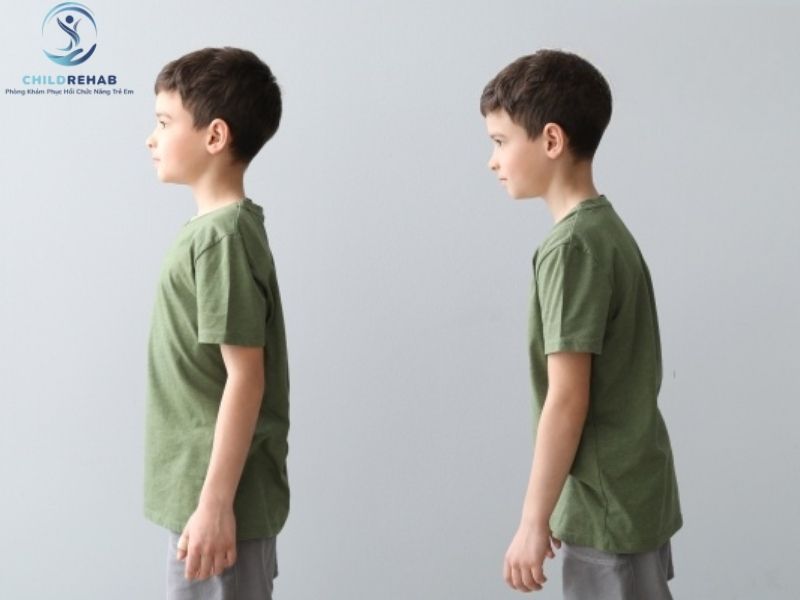 Dáng Đứng Của Trẻ Bị Gù Lưng Thường Có Gì Khác Thường? 2026 | ChildRehab
