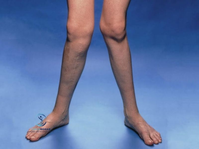 Trẻ Có Chân Chữ X Có Tự Hết Không? 2026 | ChildRehab