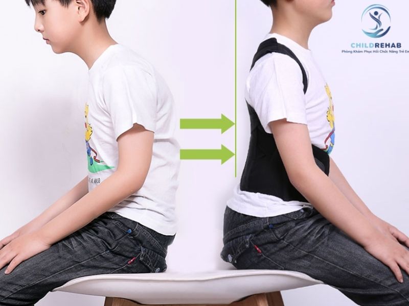 Gù Lưng Ở Trẻ Có Liên Quan Đến Lệch Vai Không? 2026 | ChildRehab