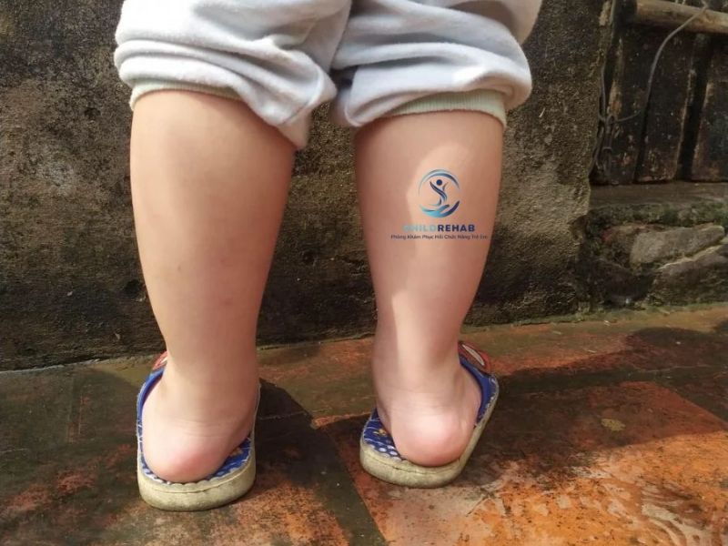 Bài Tập Cho Trẻ Bàn Chân Bẹt Tại Nhà 2026 | ChildRehab