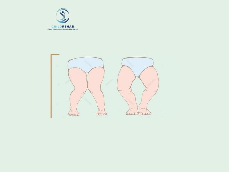 Bài Tập Cho Trẻ Chân Chữ X Tại Nhà 2026 | ChildRehab