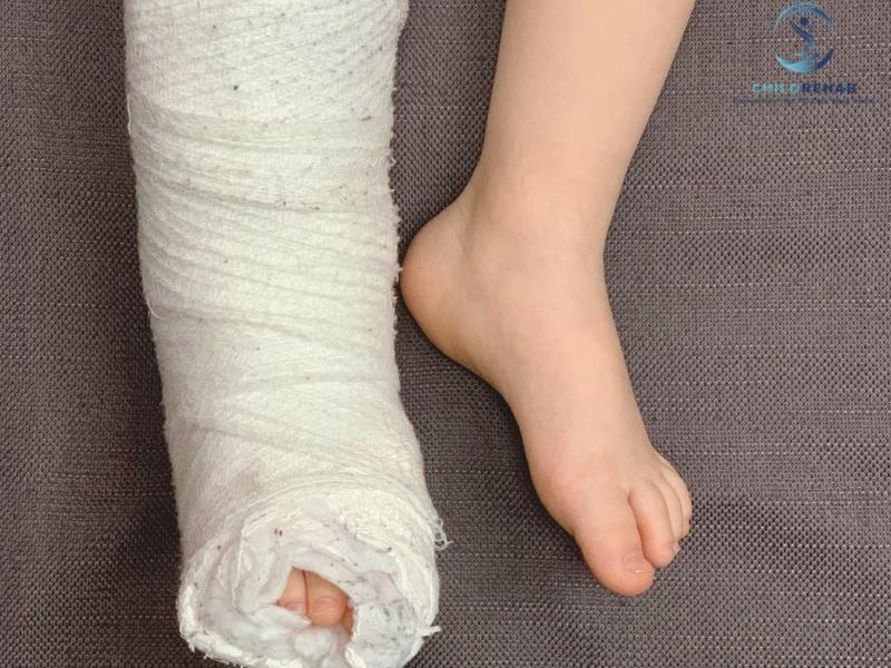 Lệch Trục Chi Dưới Ở Trẻ Có Nguy Hiểm Không? 2026 | ChildRehab