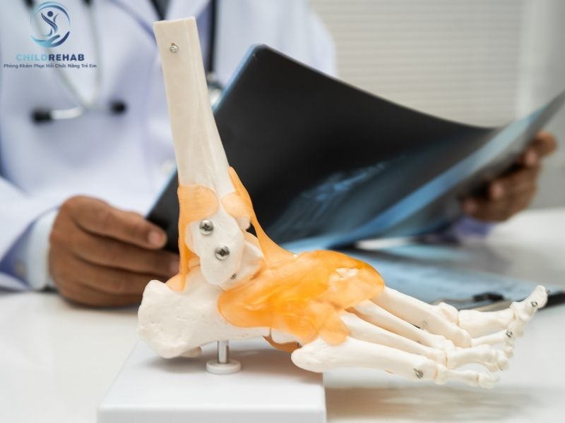 Cấu Trúc Xương Và Khớp Có Ảnh Hưởng Đến Lệch Trục Chi Dưới Ở Trẻ Không? 2026 | ChildRehab