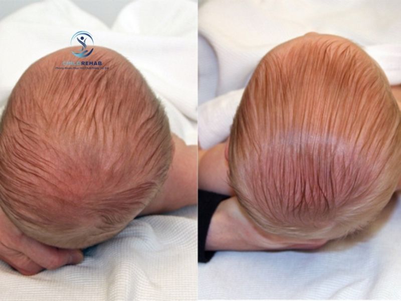 Vẹo Cổ Ở Trẻ Có Gây Méo Đầu Không? 2026 | ChildRehab