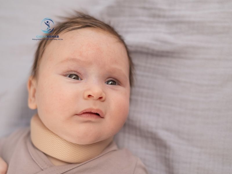 Trẻ Bị Vẹo Cổ Có Cần Đeo Nẹp Không? 2026 | ChildRehab