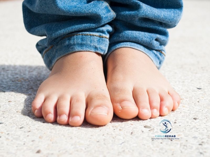 Trẻ Đi Chân Xệch, Bước Không Vững Có Liên Quan Bàn Chân Bẹt Không? 2026 | ChildRehab