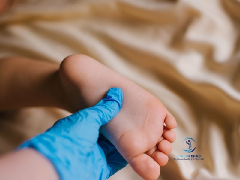 Khi Nào NÊN Đưa Trẻ Đi Kiểm Tra Bàn Chân Bẹt? 2026 | ChildRehab