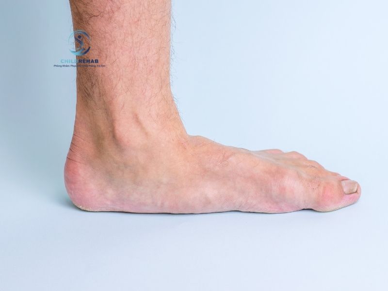 Bàn Chân Bẹt Ở Trẻ Có Nguy Hiểm Không? 2026 | ChildRehab