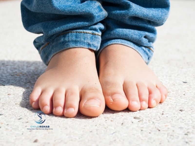 Bàn Chân Bẹt Ở Trẻ Có Gây Đau Chân Không? 2026 | ChildRehab
