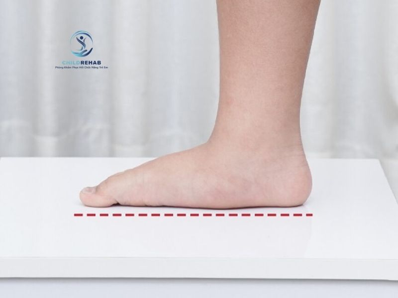 Bàn Chân Bẹt Ở Trẻ Có Làm Dáng Đi Bất Thường Không? 2026 | ChildRehab