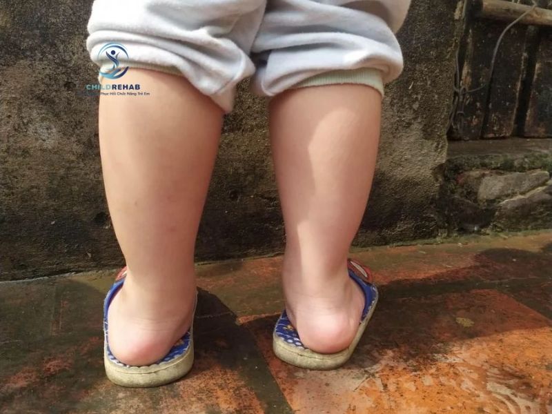 Bàn Chân Bẹt Có Ảnh Hưởng Đến Cột Sống Của Trẻ Không? 2026 | ChildRehab