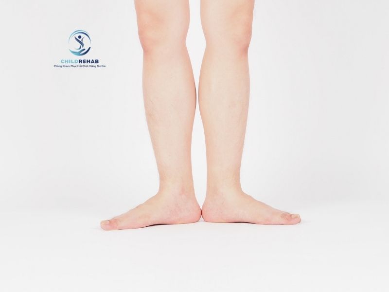 Hậu Quả Nếu Bàn Chân Bẹt Ở Trẻ Không Được Can Thiệp Sớm 2026 | ChildRehab