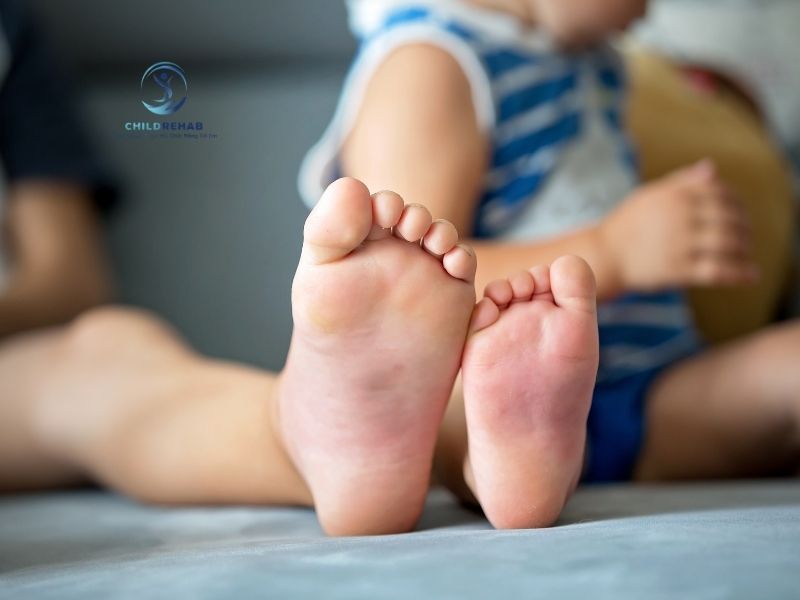 Khi Nào Trẻ Bị Bàn Chân Bẹt CẦN Can Thiệp? 2026 | ChildRehab