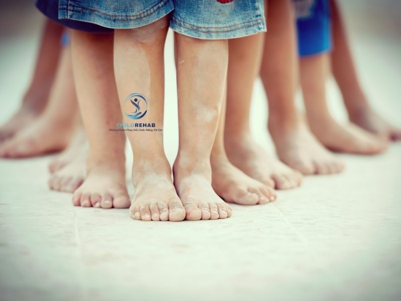 Cách Nhận Biết Trẻ Bị Chân Chữ X Tại Nhà Đơn Giản Mà Phụ Huynh Nên Biết 2026 | ChildRehab