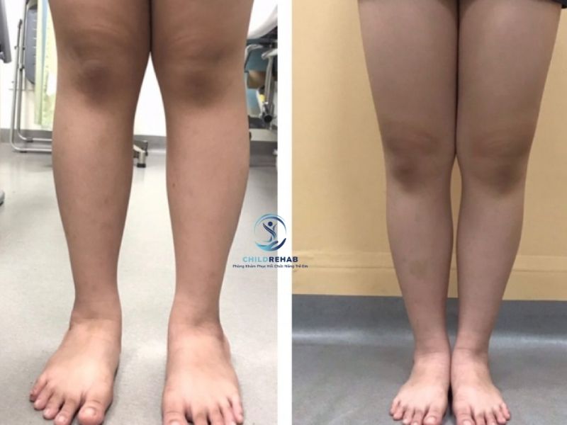 Chân Chữ X Nặng Ở Trẻ Có Biểu Hiện Gì? Khi Nào Cần Đánh Giá Chuyên Môn 2026 | ChildRehab