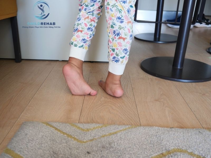 Dáng Đi Của Trẻ Đi Bằng Mũi Chân Có Gì Khác Thường? 2026 | ChildRehab