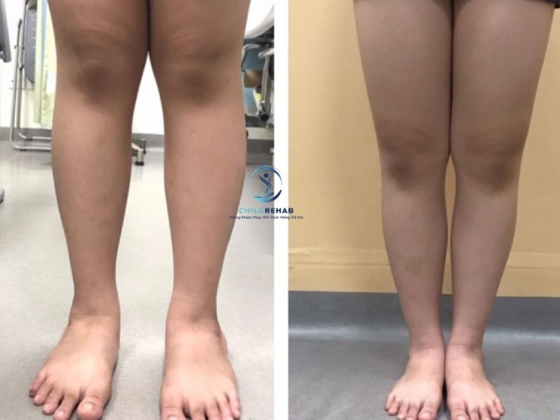 Con Tôi Đi Đứng Bình Thường Nhưng Hai Gối Chụm Vào Nhau, Có Đáng Lo Không? 2026 | ChildRehab