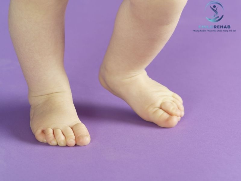 Trẻ Đi Bằng Mũi Chân Có Liên Quan Đến Căng Cơ Bắp Chân Không? 2026 | ChildRehab