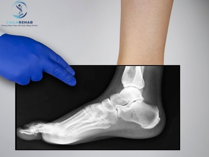 Trẻ Đi Bằng Mũi Chân Có Cần Chụp X-Quang Hoặc Kiểm Tra Chuyên Sâu Không? 2026 | ChildRehab