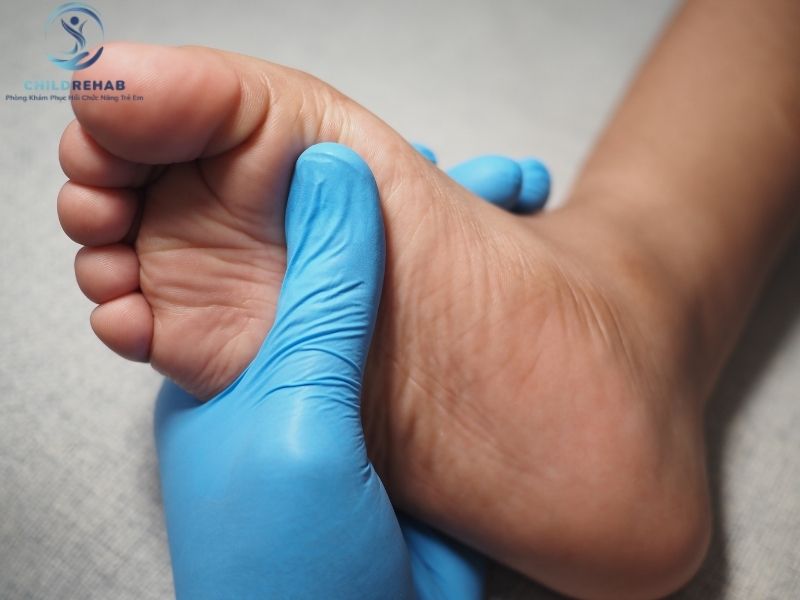 Trẻ Đi Bằng Mũi Chân Có Cần Điều Trị Không? 2026 | ChildRehab