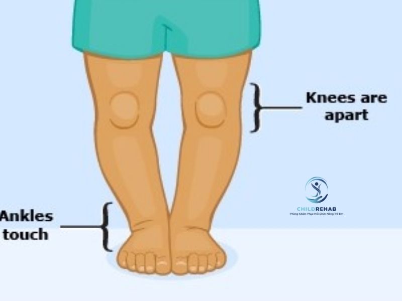 Trẻ Bị Chân Chữ O Có Sao Không? Khi Nào Là Bình Thường, Khi Nào Cần Lo 2026 | ChildRehab