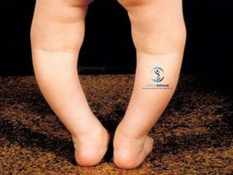 Bé Bị Chân Chữ O Có Tự Hết Không? Giải Đáp Phụ Huynh Cần Biết 2026 | ChildRehab