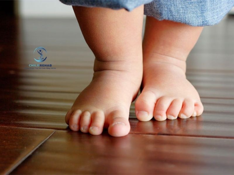 Chân Chữ O Ở Trẻ Có Nguy Hiểm Không? Những Điều Phụ Huynh Không Nên Chủ Quan 2026 | ChildRehab