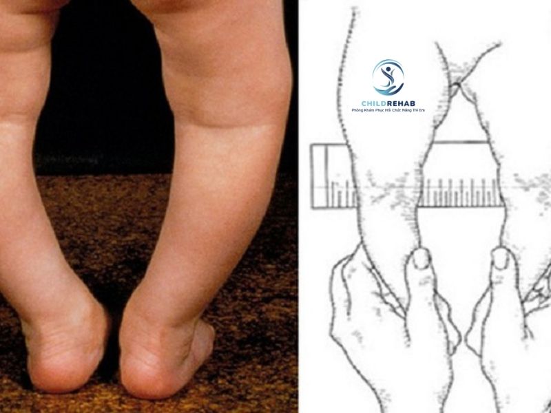 Chân Chữ O Ở Trẻ Có Ảnh Hưởng Đến Dáng Đi Và Phát Triển Vận Động Không? 2026 | ChildRehab