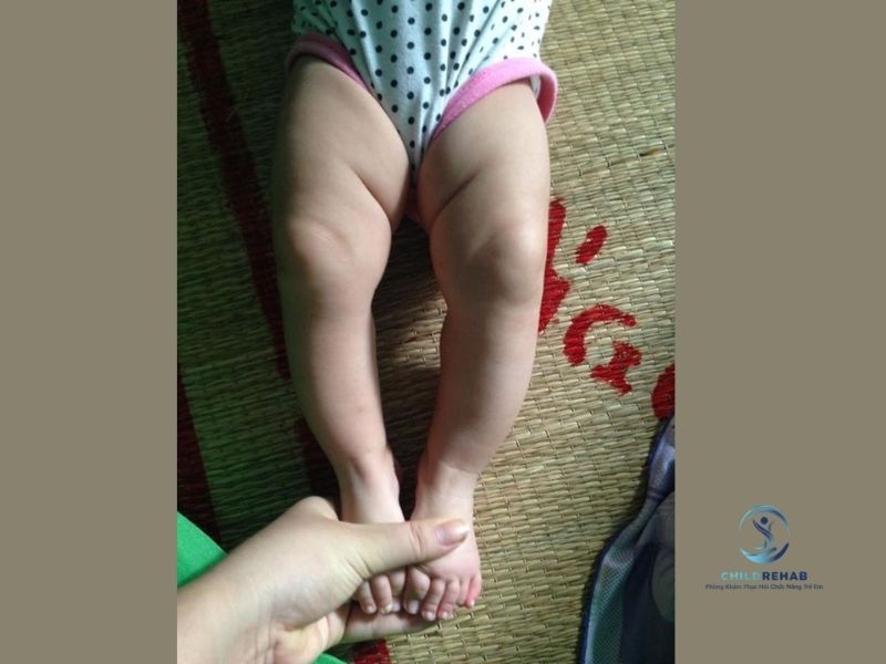 Dấu Hiệu Chân Chữ O Ở Trẻ Phụ Huynh Có Thể Nhận Biết Sớm Tại Nhà 2026 | ChildRehab