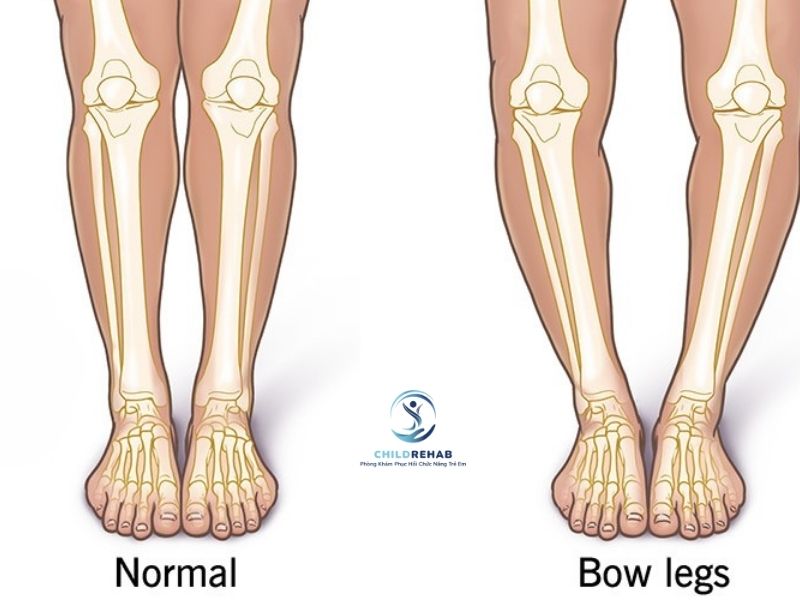 Cách Nhận Biết Trẻ Bị Chân Chữ O Tại Nhà Đơn Giản Mà Phụ Huynh Nên Biết 2026 | ChildRehab