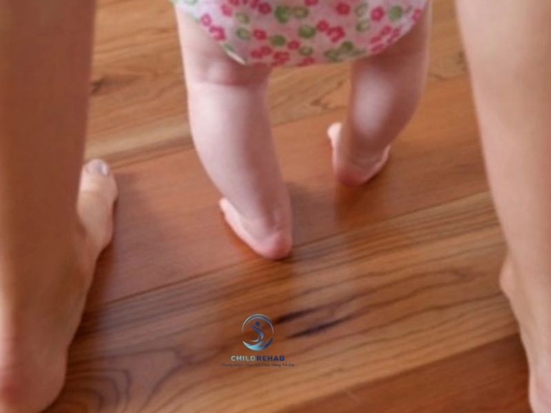 Chân Chữ O Nặng Ở Trẻ Có Biểu Hiện Gì? Khi Nào Cần Đánh Giá Chuyên Môn 2026 | ChildRehab