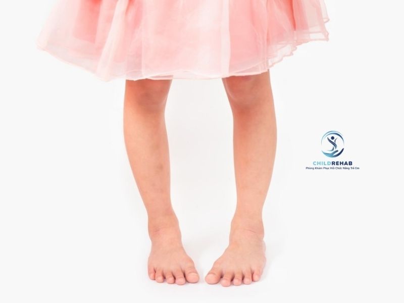 Trẻ Đứng Khép Cổ Chân Nhưng Hai Đầu Gối Cách Xa Có Phải Chân Chữ O Không? 2026 | ChildRehab