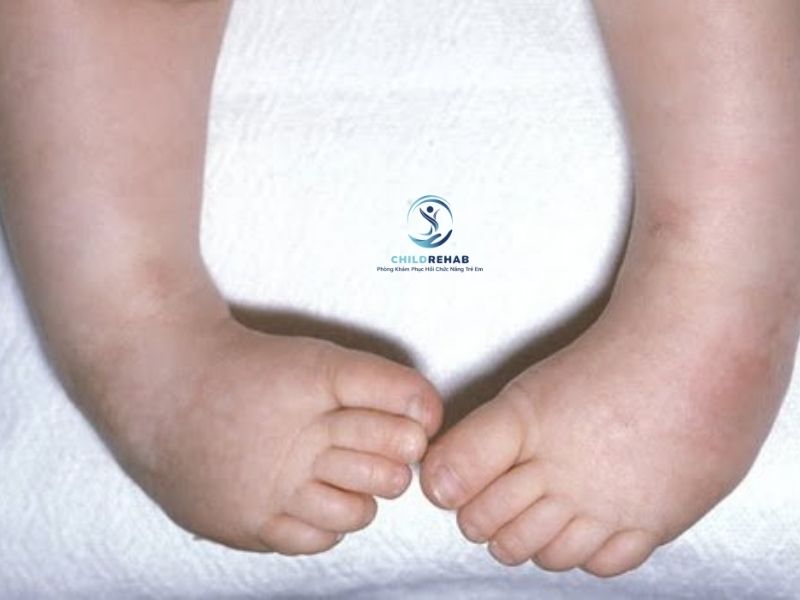 Chân Chữ O Ở Trẻ Có Phải Do Thiếu Canxi Không? 2026 | ChildRehab