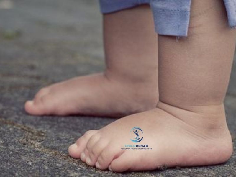 Trẻ Thừa Cân Có Dễ Bị Chân Chữ O Hơn Không? 2026 | ChildRehab