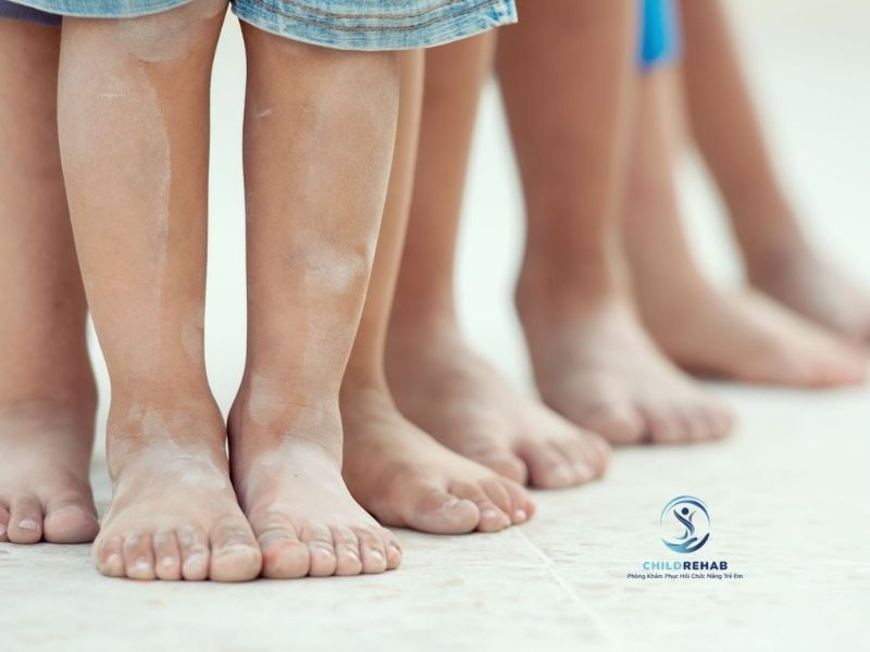 Chân Chữ O Ở Trẻ Có Di Truyền Không? 2026 | ChildRehab