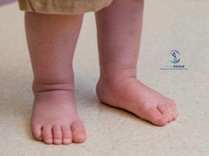 Chân Chữ O Ở Trẻ 1 Tuổi Có Bình Thường Không? 2026 | ChildRehab