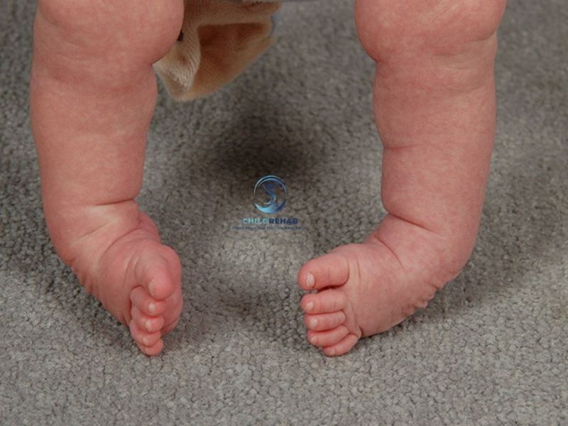 Chân Chữ O Ở Trẻ 2 Tuổi Có Tự Hết Không? 2026 | ChildRehab