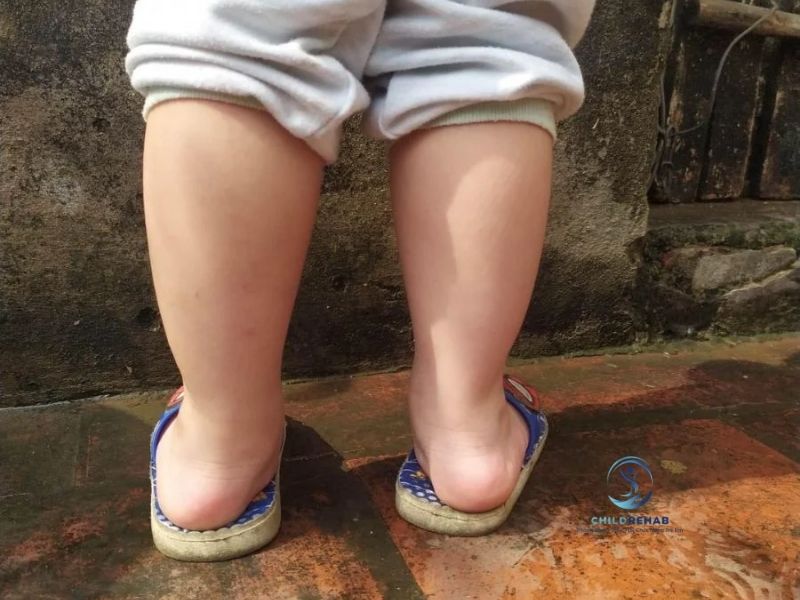 Chân Chữ O Ở Trẻ 3 Tuổi Có Cần Can Thiệp Không? 2026 | ChildRehab