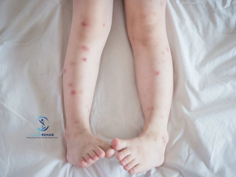 Chân Chữ O Ở Trẻ 5 Tuổi Và Những Dấu Hiệu Không Nên Chủ Quan 2026 | ChildRehab